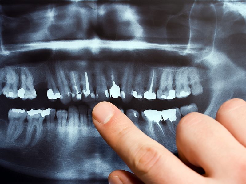 endodontie clichy