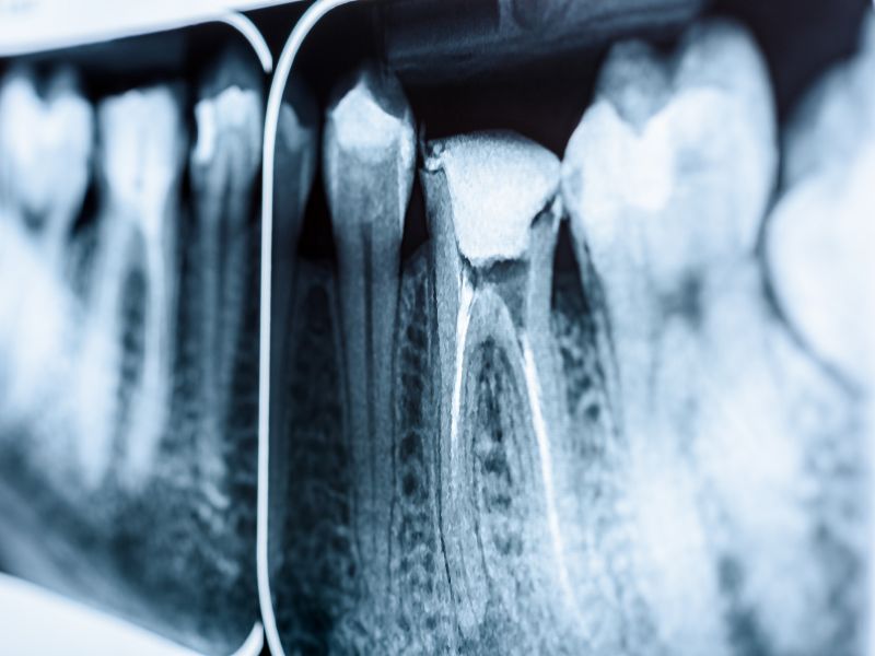 endodontie clichy